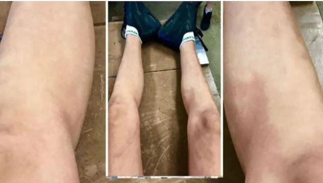  Amber suffered shocking injuries to her legs after she was attacked by a group of boys