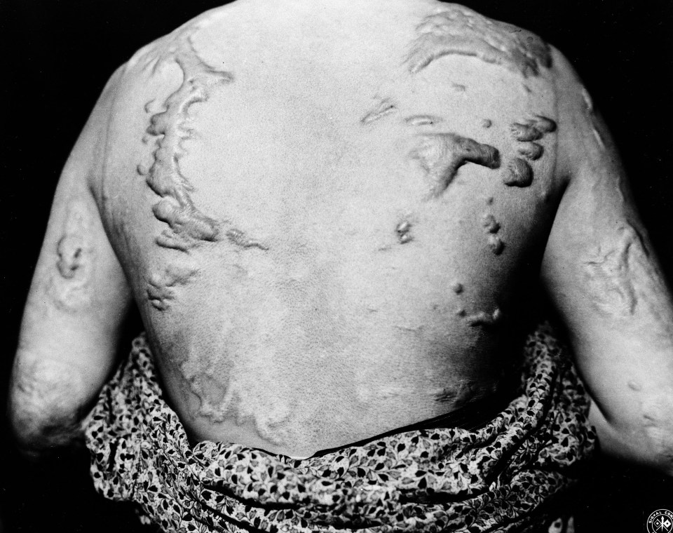 A victim shows scarring from the extensive burns