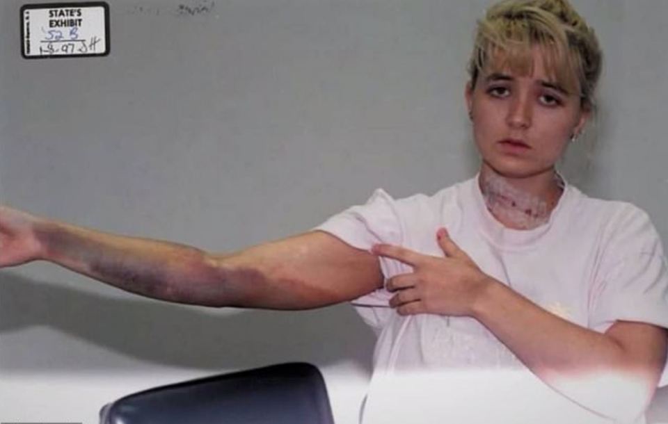 There was also extensive bruising to her arm