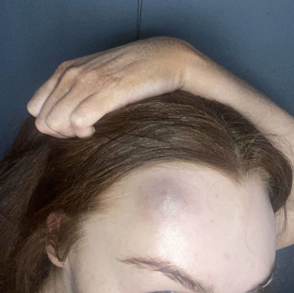 A bruise on Lynsay's head from when she lost consciousness and fell