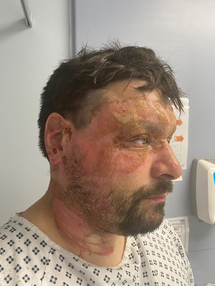 Carl Lowery underwent multiple surgeries and a skin graft following an work injury