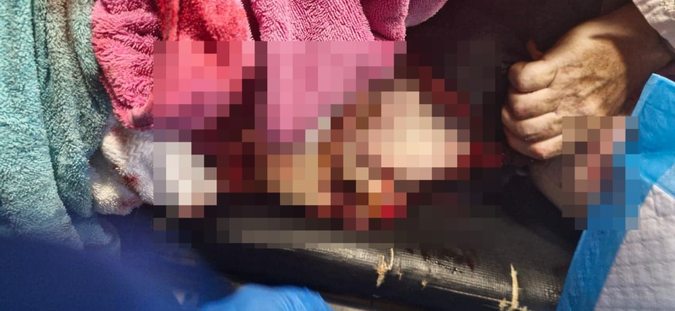 Peter suffered severe injuries to his arm, leg, and stomach