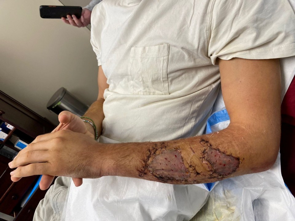 Angus's shark bite. A man survived a shark attack - and is getting the teeth left embedded in his arm turned into jewellery. Angus Kockott, 20, was out snorkelling in the shallow water off the island of Mangareva, French Polynesia. Out of nowhere, a 2.5m shark approached him from behind a reef - and clamped its jaws on his arm. Quick-thinking Angus pulled a knife - used for cutting diving lines - from his pocket and stabbed the shark WHERE before swimming to safety.