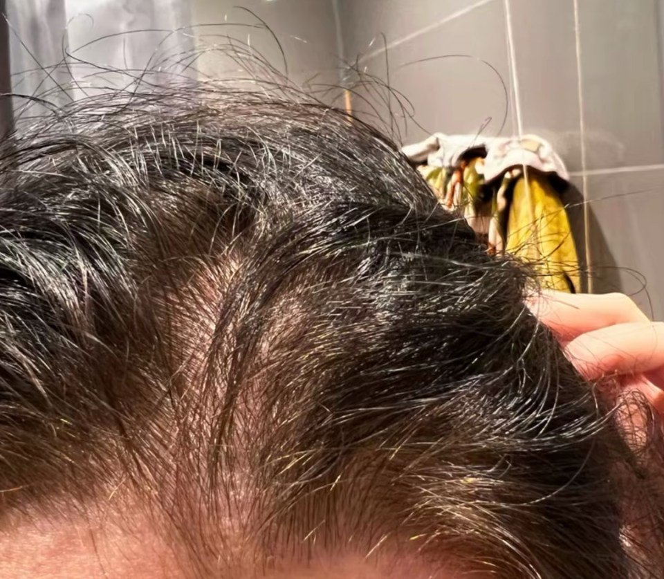 Close-up of thinning hair on a person's scalp.