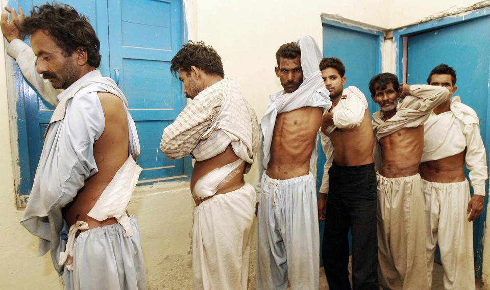 Two men in a police station showing scars from kidney removal.