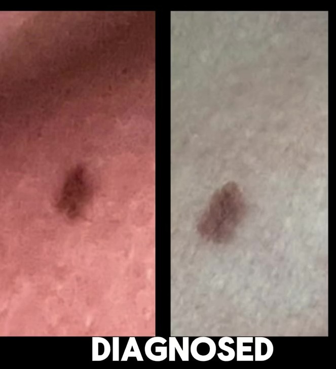 Before and after images of a skin lesion diagnosed with skin cancer.