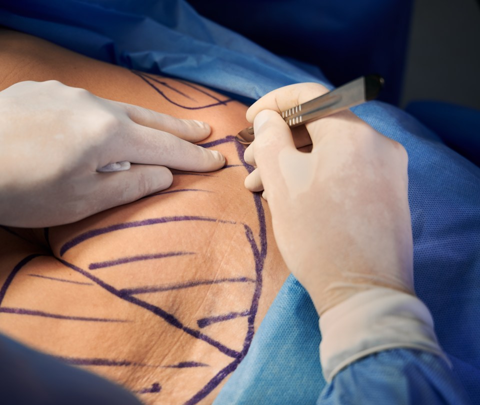 Close-up of a surgeon's hands in sterile gloves making an incision on a patient's abdomen during abdominoplasty.