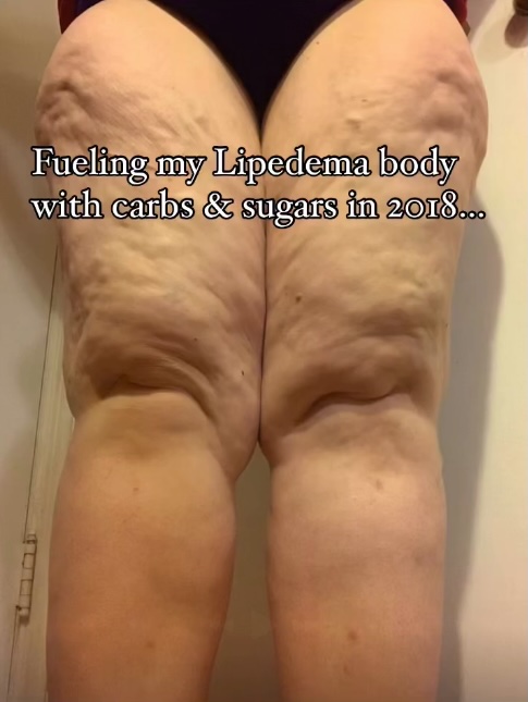 Woman's legs before weight loss, showing lipedema.