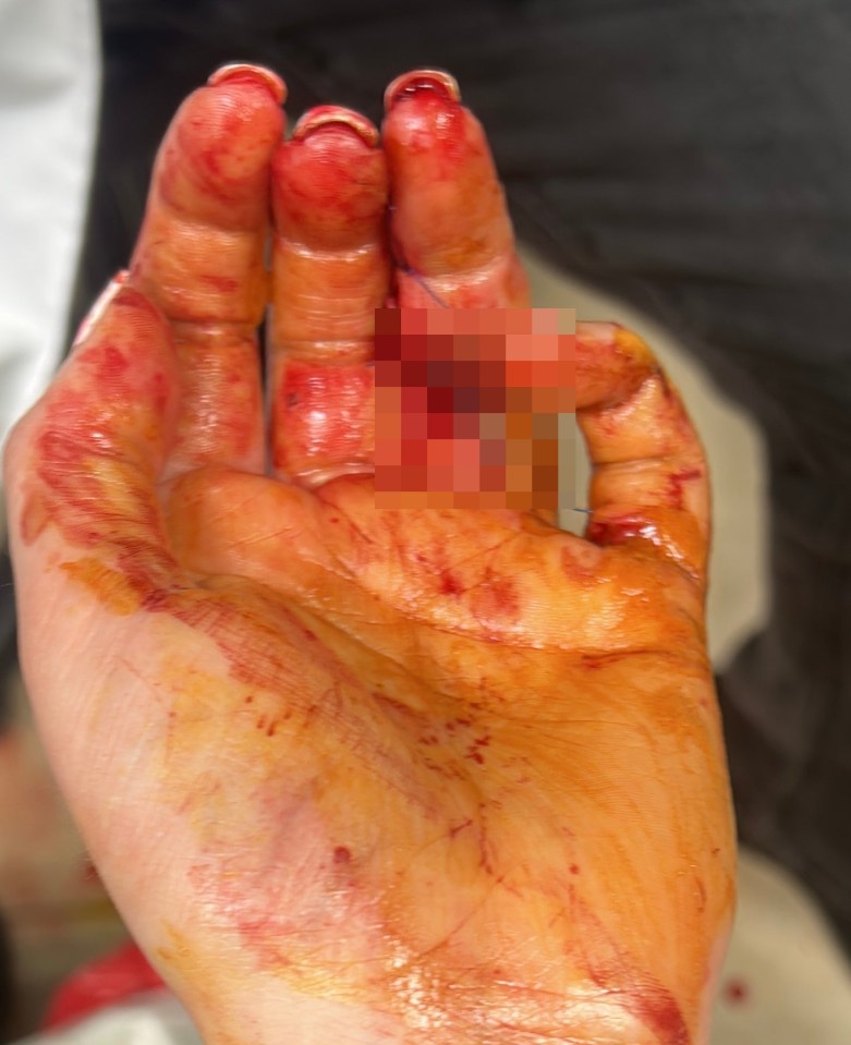Severely injured hand with a deep wound to the ring finger.